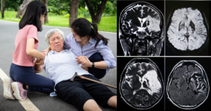 โรคหลอดเลือดสมอง (Stroke) ในผู้สูงอายุ