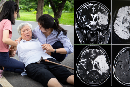 การช่วยเหลือผู้สูงอายุจากภาวะโรคหลอดเลือดสมอง (Stroke) ฉุกเฉิน พร้อมผลตรวจวินิจฉัยสมอง